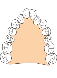 歯列に合わせた拡大装置を作ります