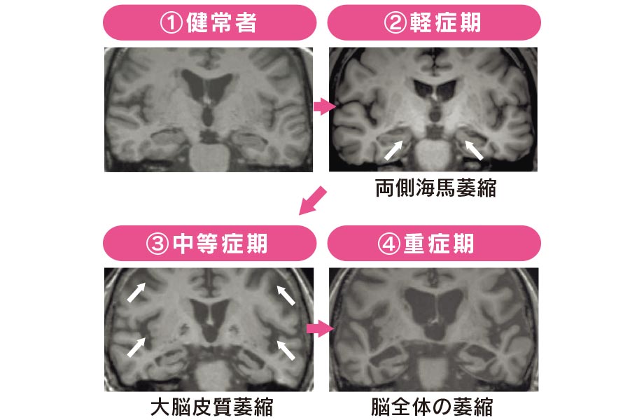 アルツハイマー型認知症の 進行-MRI画像