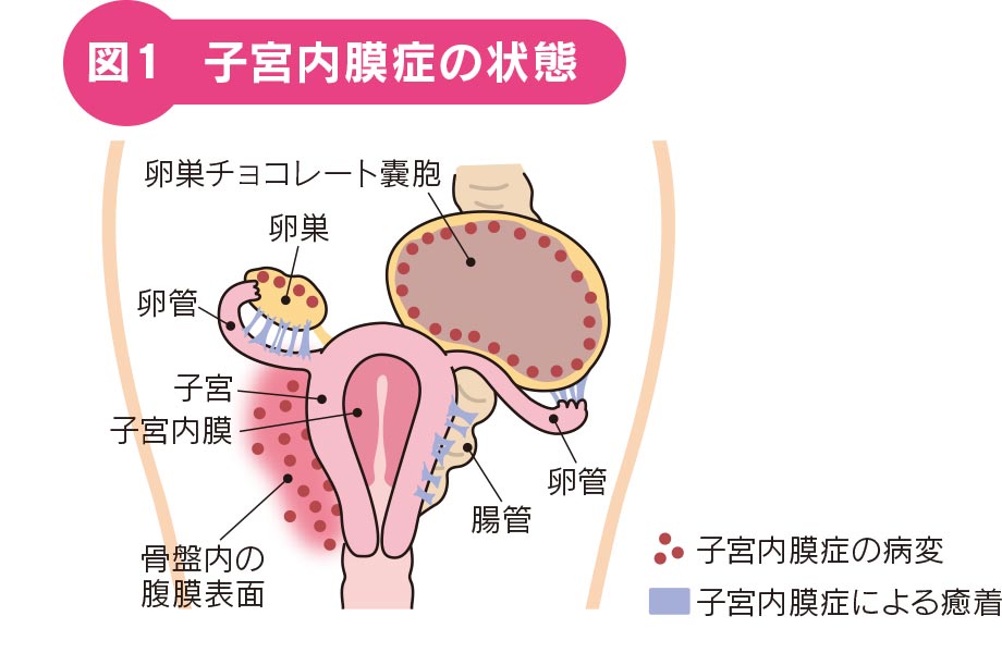 図1 子宮内膜症の状態