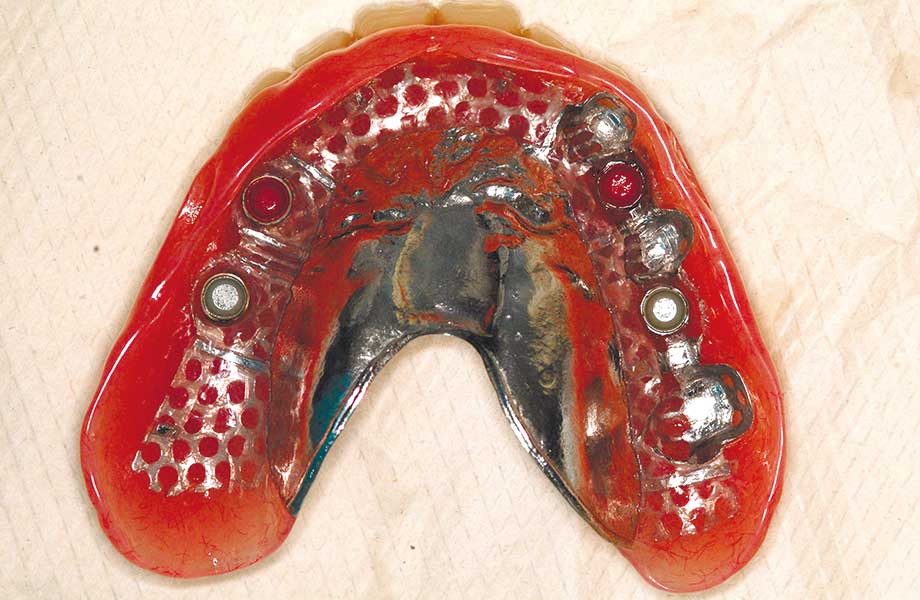 部分入れ歯とインプラントを組み合わせる方法