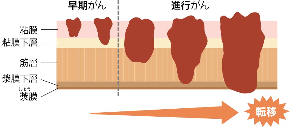 がんが粘膜とそのすぐ下の層（粘膜下層）にとどまっているものを「早期がん」、それより深く広がったものを「進行がん」と呼びます