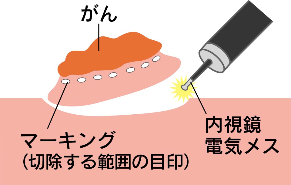 内視鏡的粘膜下層剥離術：ESD