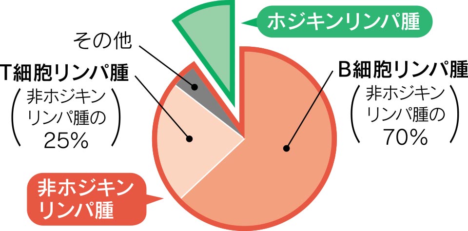 悪性リンパ腫の種類と日本における割合