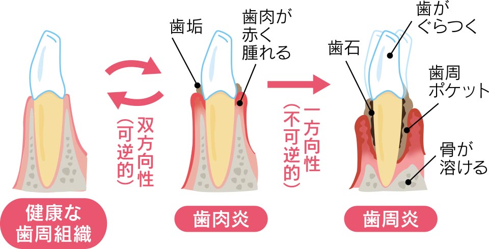歯周炎が継続し病原性の高い口腔フローラへ変化すると、歯を支えている骨が溶けて歯が動くようになり、最後には歯が抜けていきます。歯周炎になると健康な状態へ戻ることが難しくなります