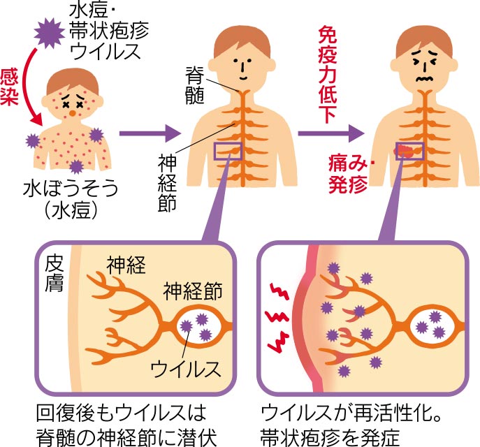 帯状疱疹発症の仕組みの図説