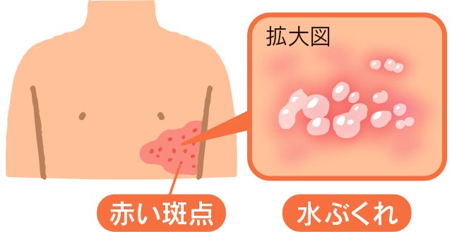帯状疱疹の症状