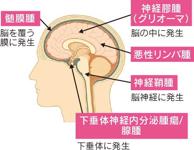 髄膜腫は脳を覆う膜に発生、神経膠腫(グリオーマ)と悪性リンパ腫は脳の中に発生、神経鞘腫は脳神経に発生、下垂体神経内分泌腫瘍/腺腫は下垂体に発生