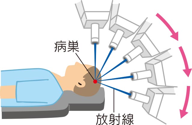 サイバーナイフ照射イメージ